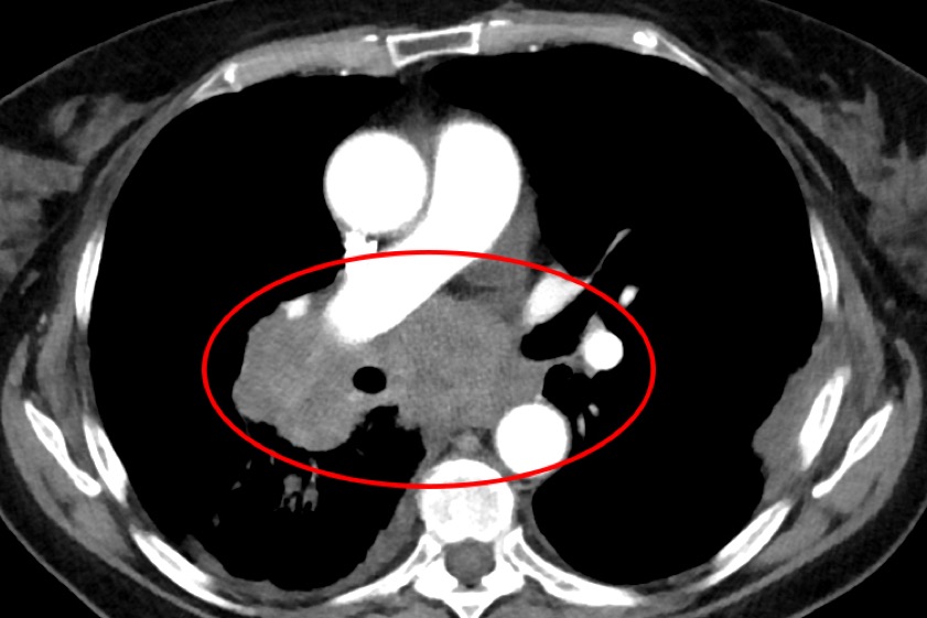 Aufnahme eines kleinzelligen Lungenkarzinoms, das zentral wächst und insbesondere den rechten Hauptbronchus einengt. Fotos: Klinikum Ingolstadt